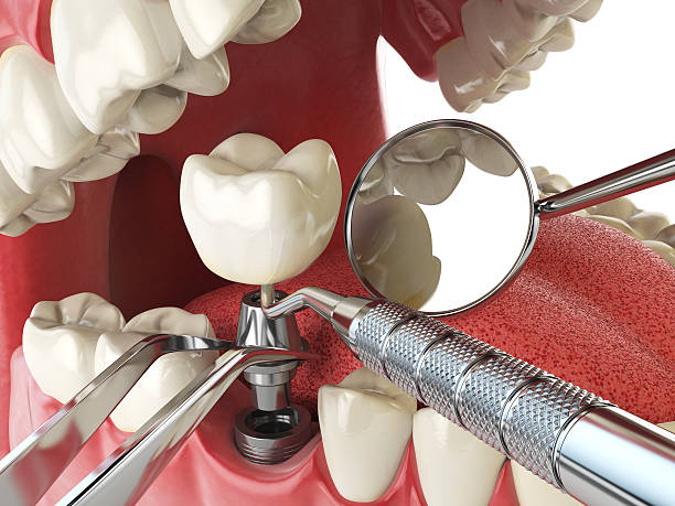 Best Broken or Chipped Tooth Repair in Brigham City, UT
